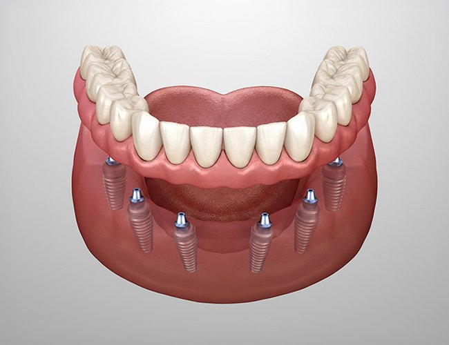 All-on-5・All-on-6にも対応 イメージ