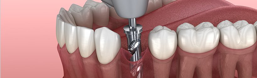 骨の幅が狭い場合に骨を広げる方法 イメージ