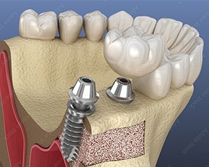 インプラント埋入手術 イメージ