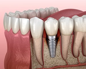 治癒・結合期間 イメージ
