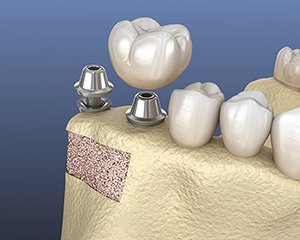 上部構造（かぶせ物）装着 イメージ