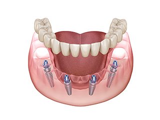 費用面や手術自体の負担を大きく軽減した治療法