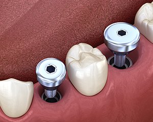 骨を守ることができます イメージ