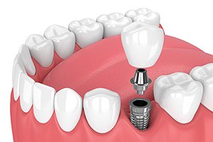 治療の流れ イメージ5