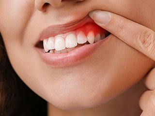 インプラント周囲炎