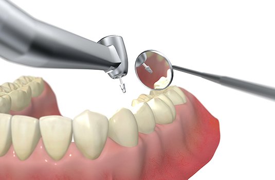 『歯を削ると弱くなります』これは事実です。 イメージ