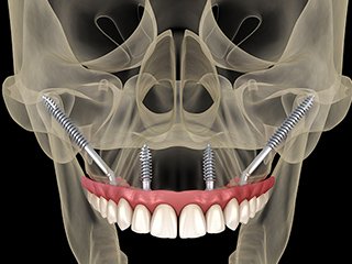上顎洞炎 イメージ