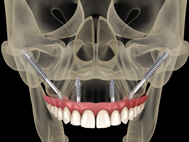 上顎洞炎 イメージ