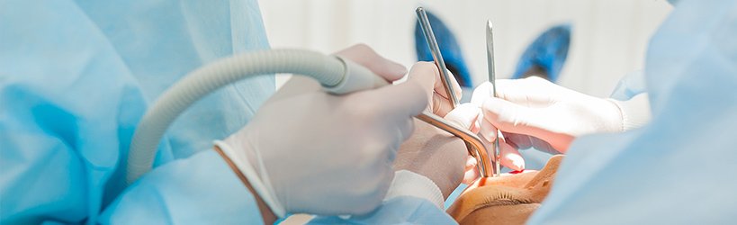 インプラント治療は手術が必要 イメージ