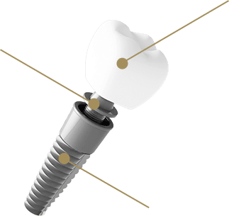 インプラントの構造 イメージ