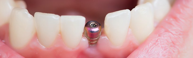 奥歯によく用いられる一回法インプラント イメージ