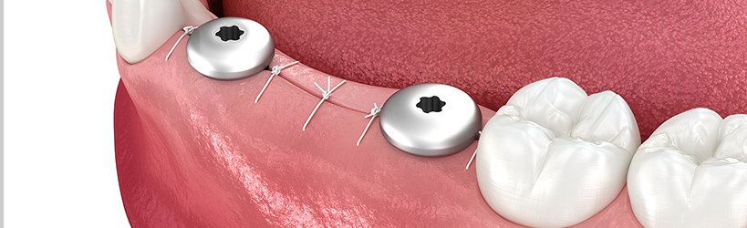 安静が必要な部位へは二回法インプラント イメージ