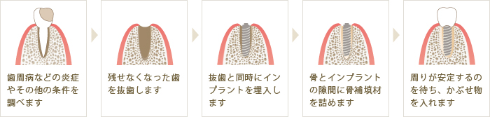 抜歯即時インプラント 治療の流れ