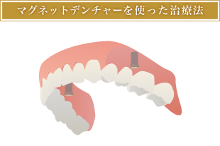 マグネットデンチャーを使った治療法