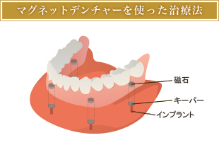 マグネットデンチャーを使った治療法