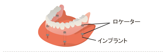 ロケーター インプラント